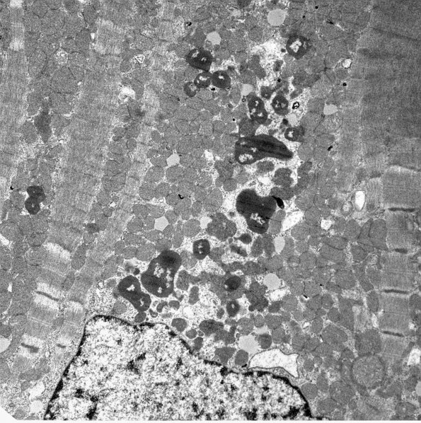 4B4 Hydroxychloroquine cardiomyopathy (Case 4) EM 004 - Copy