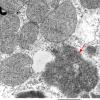 4B5 Hydroxychloroquine cardiomyopathy (Case 4) EM 006 copy - Copy