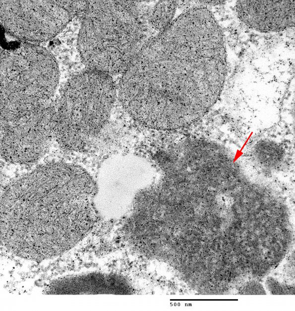 4B5 Hydroxychloroquine cardiomyopathy (Case 4) EM 006 copy - Copy