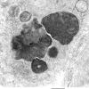 4B6 Hydroxychloroquine cardiomyopathy (Case 4) EM 007 - Copy - Copy