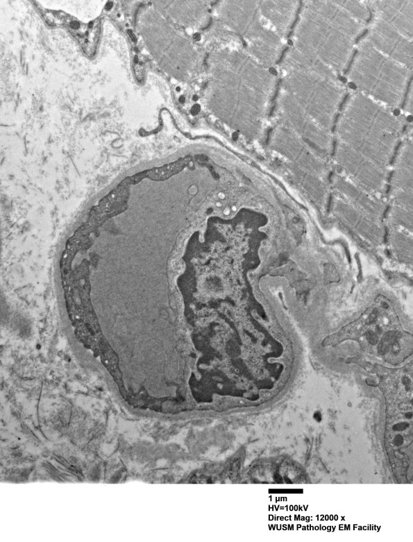 5A2 (Case 5) Muscle_015 - Copy
