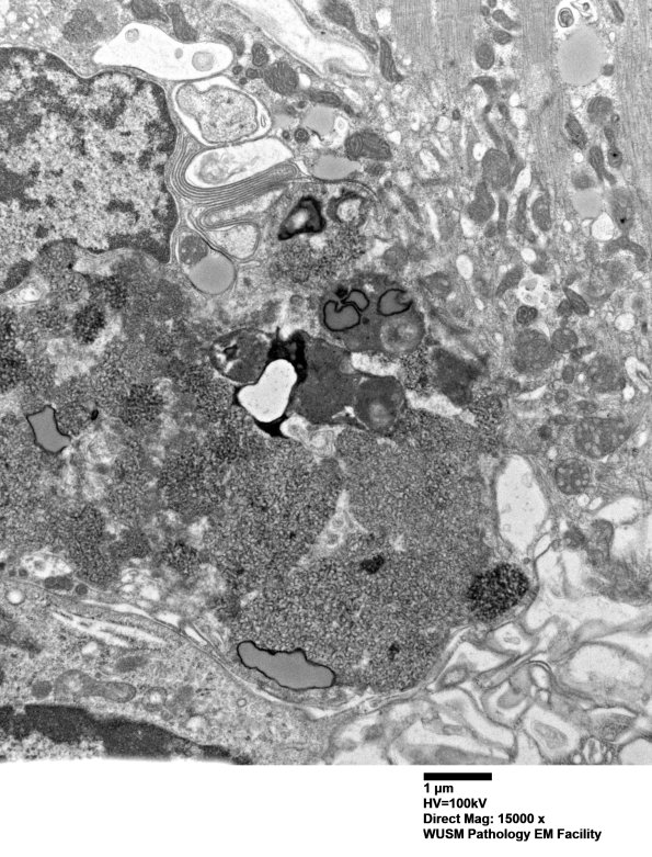 5B1B (Case 5) Muscle_050 - Copy