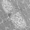 6D2A HCG (Case 6) EM 028 - Copy