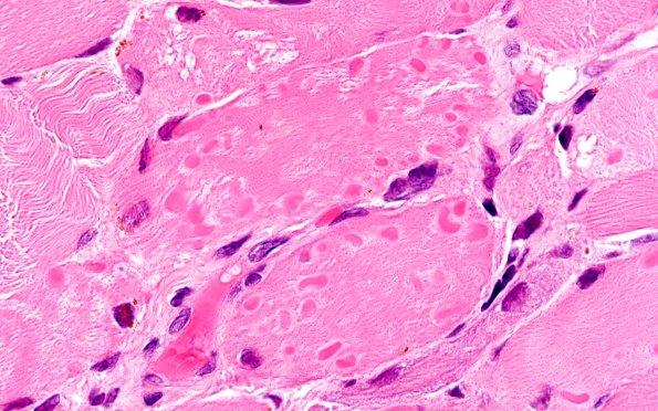 Cytoplasmic Inclusions Examples 1A2 Muscle, cytoplasmic bodies (Case 1) H&E 100X 2 | Inclusions ...
