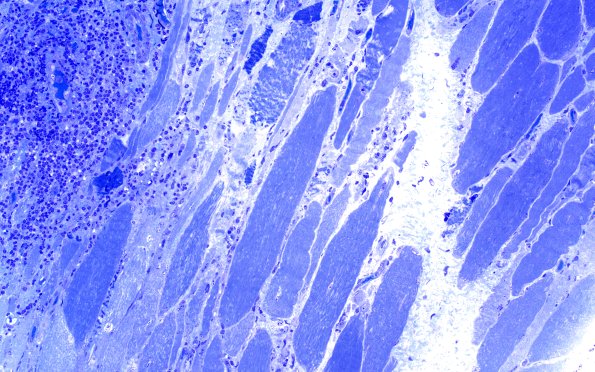 1D1Muscle, cytoplasmic bodies (Case 1) 20X 1
