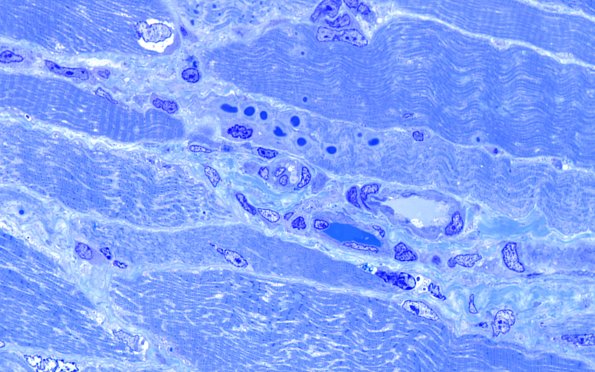 1D2 Muscle, cytoplasmic bodies (Case 1) 100X 2