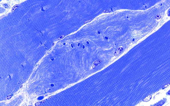 1D3 Muscle, cytoplasmic bodies (Case 1) 100X 4