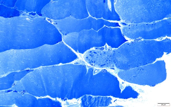 2A1A Cytoplasmic bodies (Case 2) 40X 4