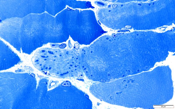 2A1B Cytoplasmic bodies (Case 2) 100X 4