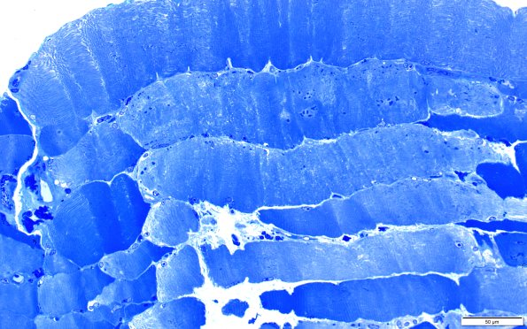 2A2A Cytoplasmic bodies (Case 2) 40X 3