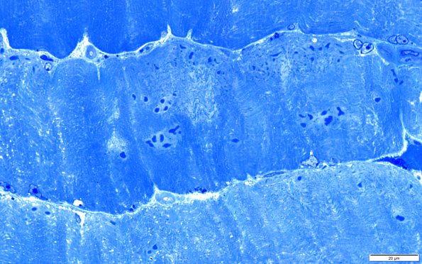 2A2C Cytoplasmic bodies (Case 2) 100X 3