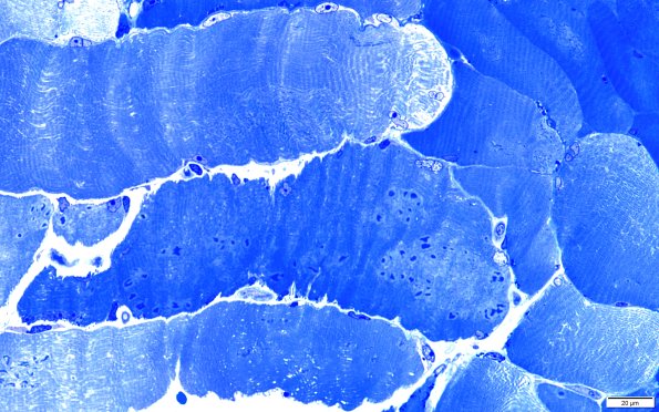2A3A Cytoplasmic bodies (Case 2) 60X 1