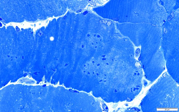 2A3B Cytoplasmic bodies (Case 2) 100X 1