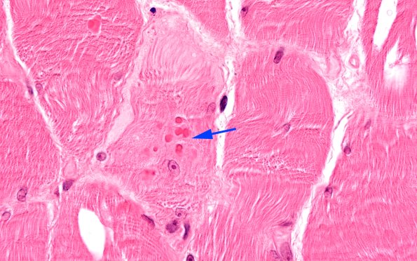 3A1 (Case 3) muscle_014