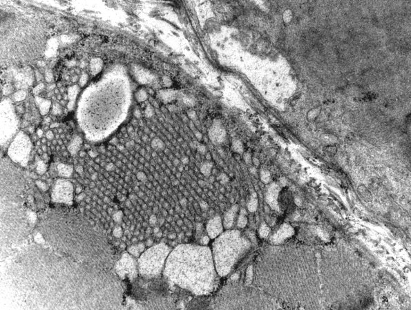 1H6A (Case 1) EM Image7, 11Kx - Copy