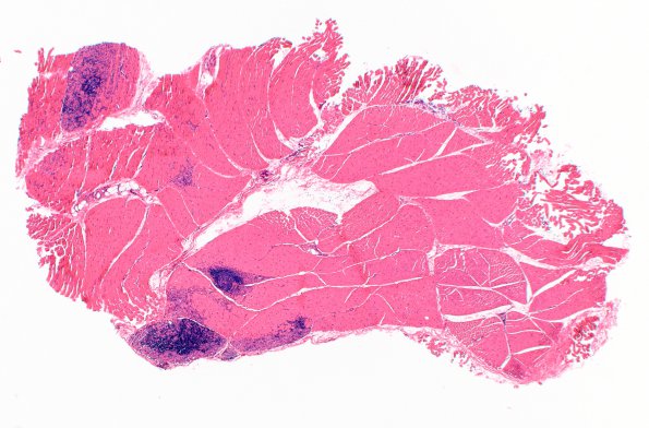 1A1 Macrophagic Myofasciitis (Case 1) H&E 2X