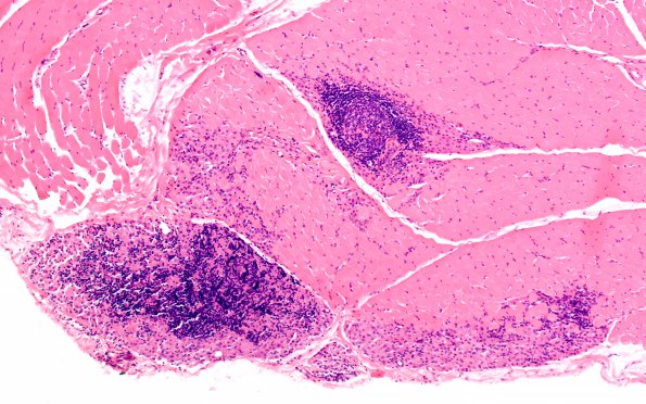 1A2 Macrophagic Myofasciitis (Case 1) H&E 1