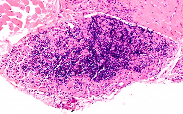 1A3 Macrophagic Myofasciitis (Case 1) H&E 10