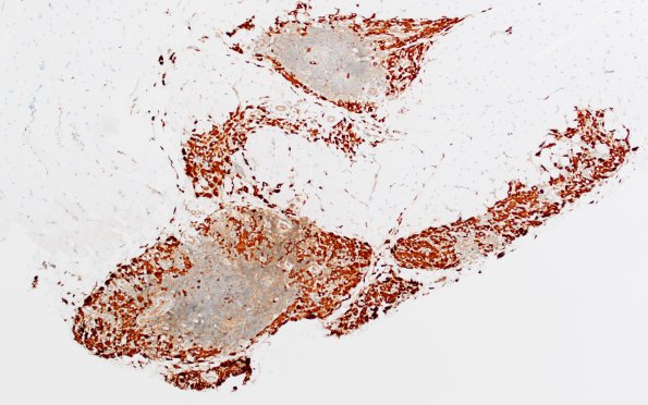 1B1 Macrophagic Myofasciitis (Case 1) CD68 4