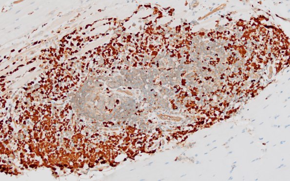 1B2 Macrophagic Myofasciitis (Case 1) CD68 2