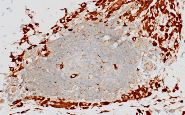 1B3 Macrophagic Myofasciitis (Case 1) CD68 6