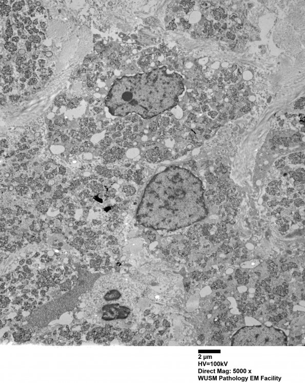 1F1 Macrophagic Myofasciitis (Case 1) Muscle EM 012 - Copy