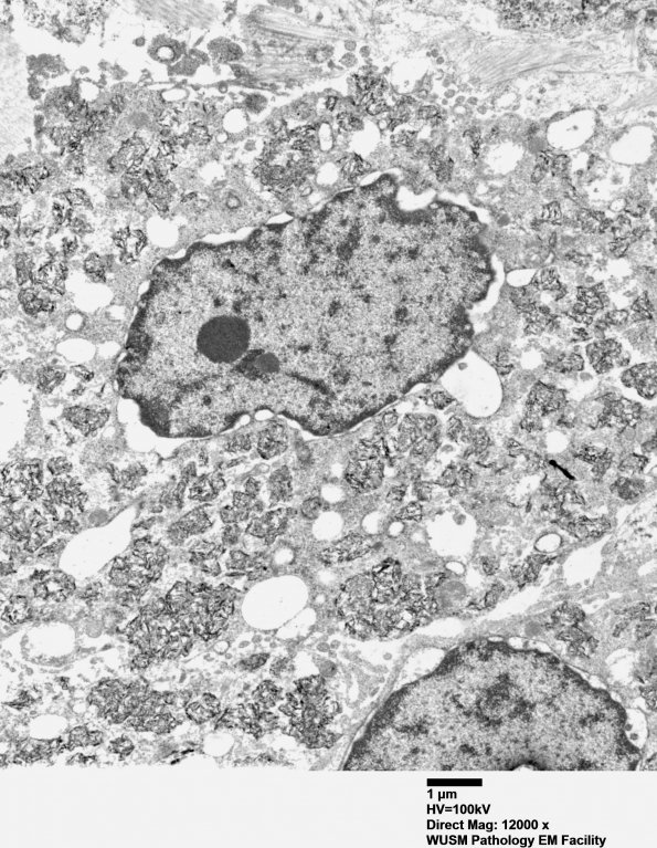 1F3 Macrophagic Myofasciitis (Case 1) Muscle EM 013 - Copy