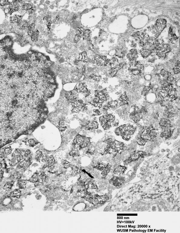 1F4 Macrophagic Myofasciitis (Case 1) Muscle EM 019 - Copy