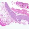 2A1 Macrophagic Myofasciitis (Case 2) H&E 4