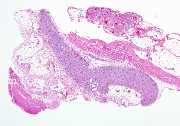 2A1 Macrophagic Myofasciitis (Case 2) H&E 4