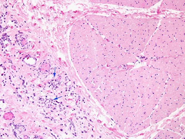 2A4 Macrophagic Myofasciitis (Case 2) H&E 11 copy