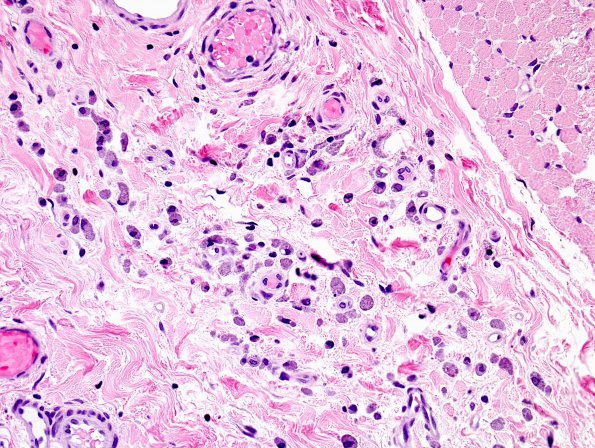 2A5 Macrophagic Myofasciitis (Case 2) H&E 1