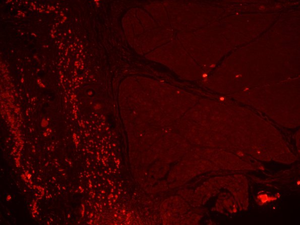 2D1 Macrophagic Myofasciitis (Case 2) Autofluorescence 1A