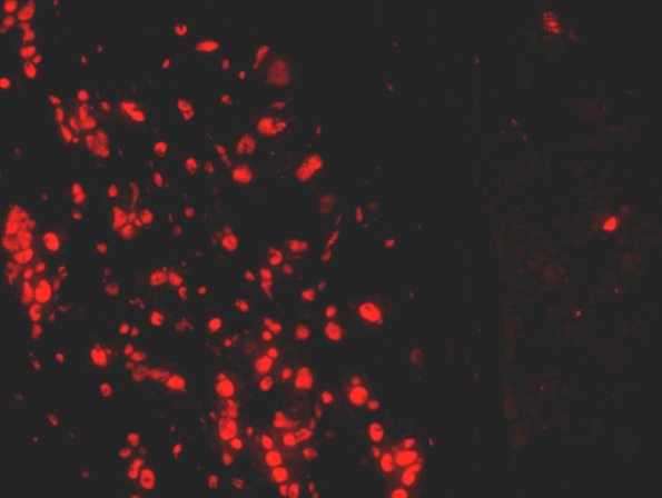 2D2 Macrophagic Myofasciitis (Case 2) Autofluorescence 1B