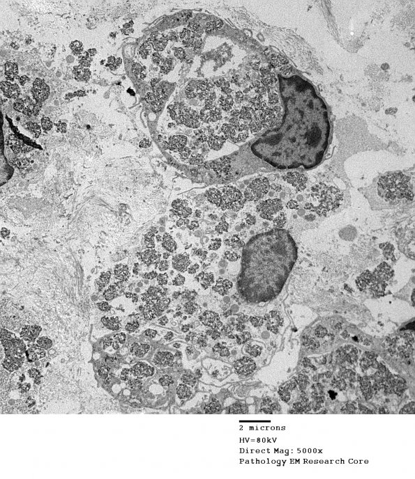 2E3 Macrophagic Myofasciitis (Case 2) EM_024 - Copy