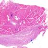 3A1 Macrophagic Myofasciitis (Case 3) H&E 5 copy