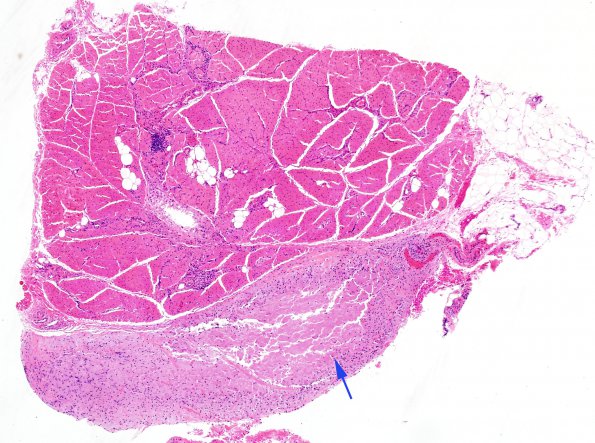 3A1 Macrophagic Myofasciitis (Case 3) H&E 5 copy