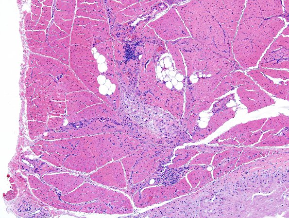 3A2 Macrophagic Myofasciitis (Case 3) H&E 4