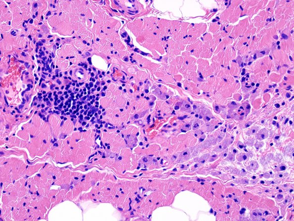3A4 Macrophagic Myofasciitis (Case 3) H&E 2