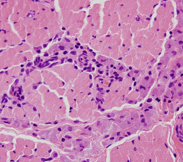 3A5 Macrophagic Myofasciitis (Case 3) H&E 1