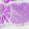 4B1 Macrophagic Myofasciitis (Case 4) PAS 2