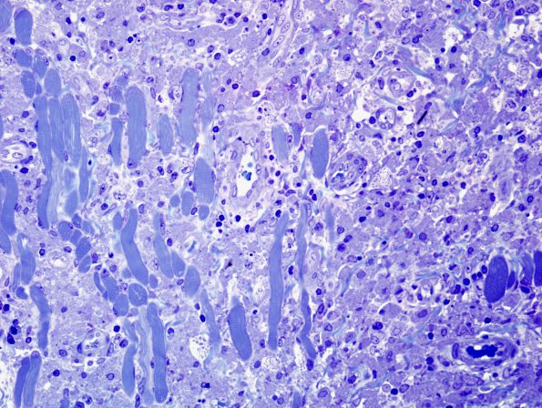 4C3 Macrophagic Myofasciitis (Case 4) Plastic 3