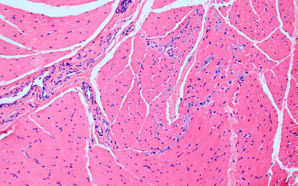 5A1 Macrophagic myofasciitis (Case 4) H&E 20X