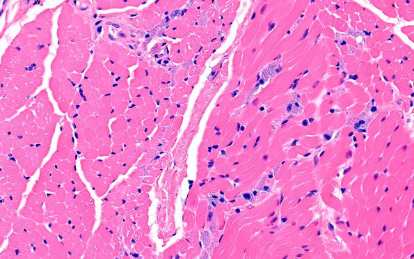 5A2 Macrophagic myofasciitis (Case 4) H&E 40X