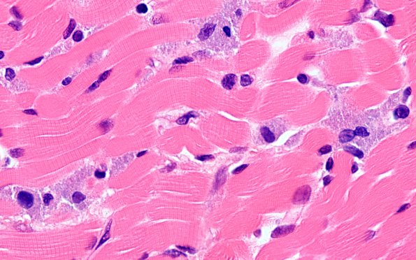 5A3 Macrophagic myofasciitis (Case 4) H&E 100X 1