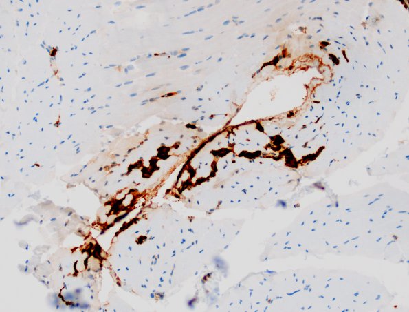 5B1 Macrophagic myofasciitis (Case 5) CD68 1