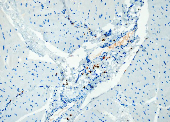 5B2 Macrophagic myofasciitis (Case 5) CD3 1