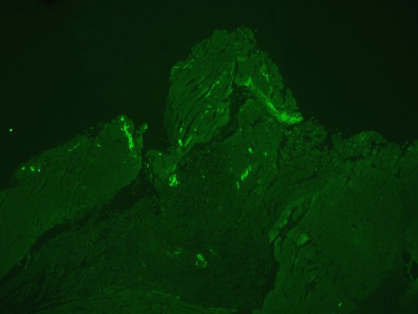 5D1 Macrophagic Myofasciitis Autofluorescence (Case 5) 7