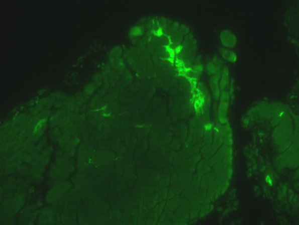 5D2 Macrophagic Myofasciitis Autofluorescence (Case 5) 3