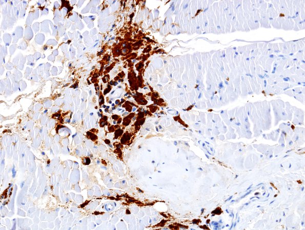 6B Macrophagic myofasciitis (Case 6) CD68 1